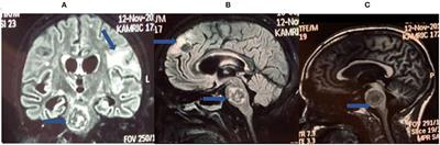 Improving Technology to Diagnose Tuberculous Meningitis: Are We There Yet?